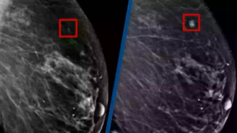 ai-in-breast-cancer